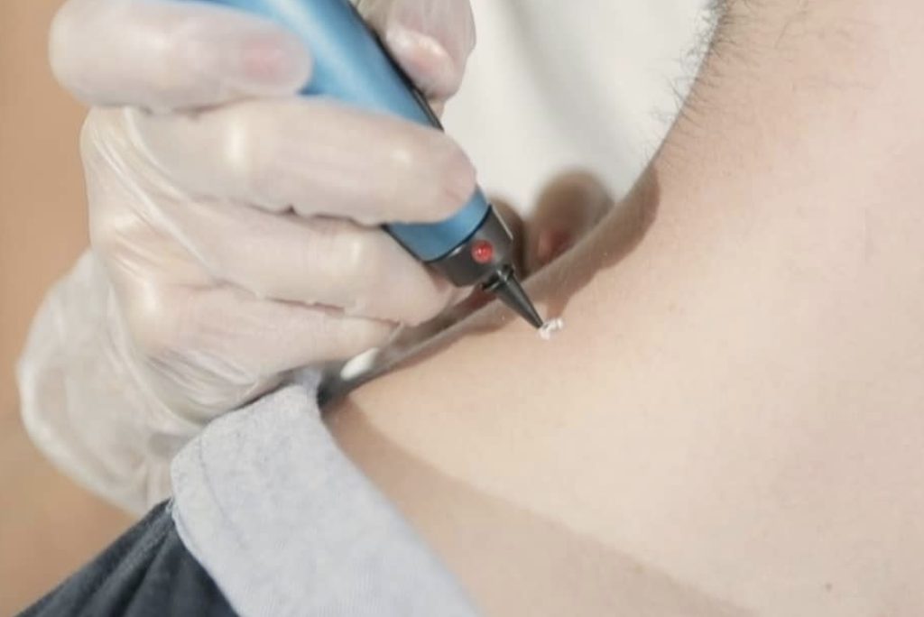 Cryopen-Use-1 - 1 We provide skin peel services